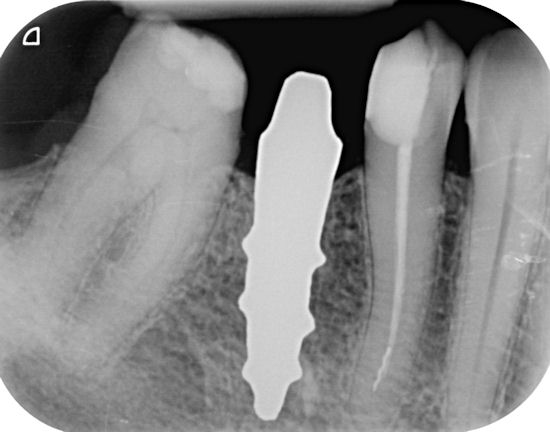 X-ray of dental implants